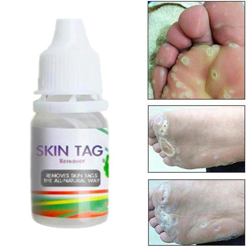 10ML Body Warts Treatment Cream Skin Tag Remover Foot Corn Removal Plantar Genital Warts Ointment Foot Care Cream Dropshopping