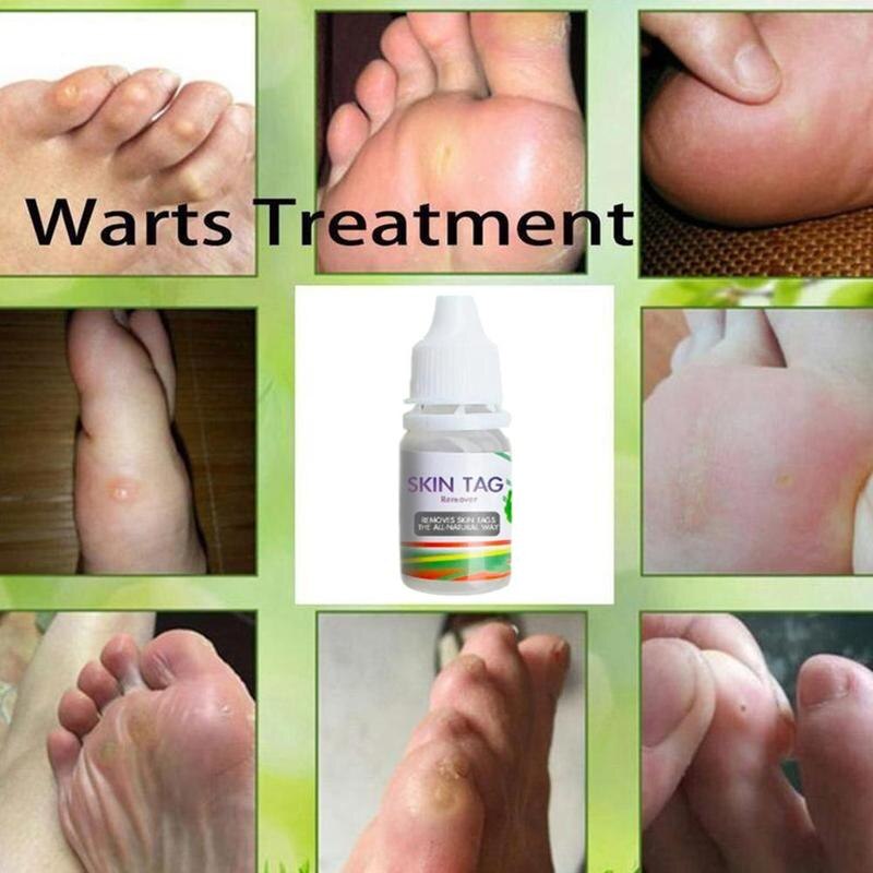 10ML Body Warts Treatment Cream Skin Tag Remover Foot Corn Removal Plantar Genital Warts Ointment Foot Care Cream Dropshopping