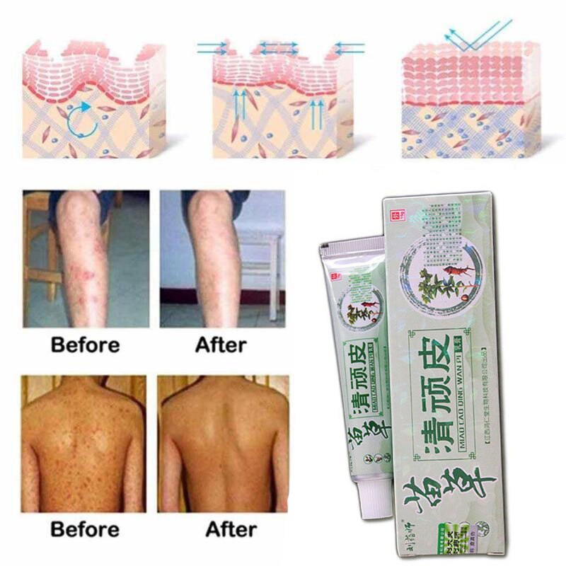Health psoriasis treatment cream Skin care Dermatitis Eczematoid Eczema Ointment eczema cream psoriasis Itching relief Ointment