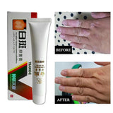 Chinese Medical White Spot Disease Cream Pigment Melanin Promoting Liniment Skin Vitiligo Leukoplakia Disease Treatment 30g