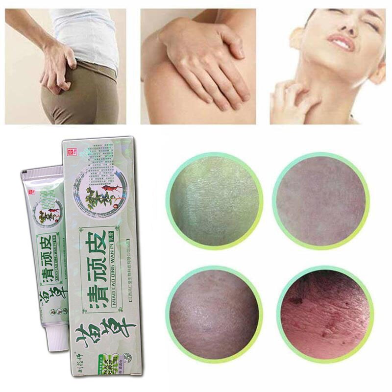 Health psoriasis treatment cream Skin care Dermatitis Eczematoid Eczema Ointment eczema cream psoriasis Itching relief Ointment
