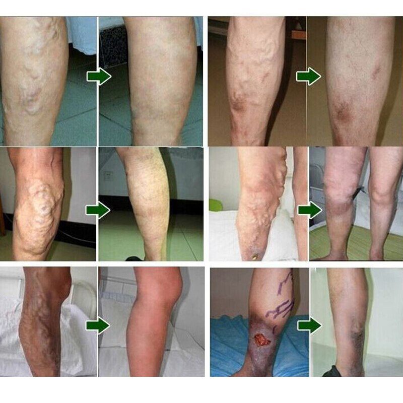 24 Pcs Spider Veins Varicose Treatment Plaster Varicose Veins Cure Patch Vasculitis Natural Solution Herbal Patches