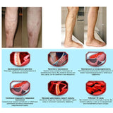 24 Pcs Spider Veins Varicose Treatment Plaster Varicose Veins Cure Patch Vasculitis Natural Solution Herbal Patches