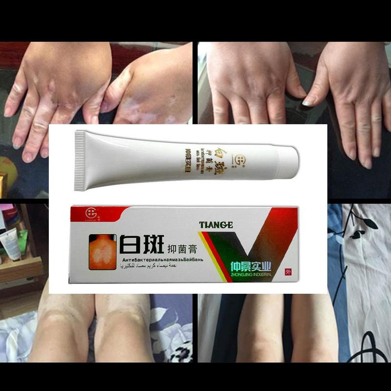 30g Chinese Medical White Spot Disease Cream Pigment  Vitiligo Leukoplakia Disease Treatment Melanin Promoting Liniment Skin