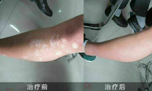 3 Packs BaiShiPills Skin Repigment TCM Therapy BAIYUNSHAN Vitiligo Treatment