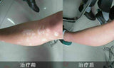 3 Packs BaiShiPills Skin Repigment TCM Therapy BAIYUNSHAN Vitiligo Treatment