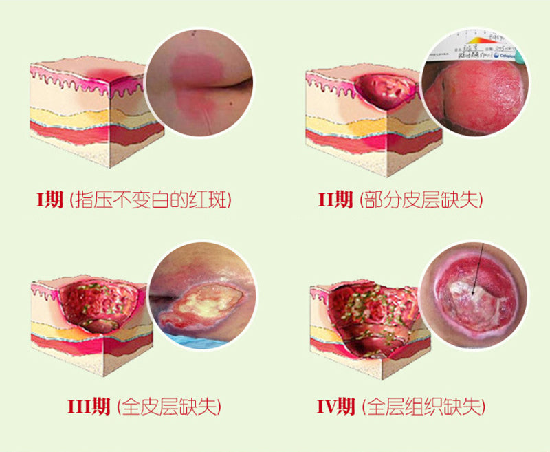 Herbal Removal Rot Myogenic Cream Bedsores Paste Treat Pressure Sores/Decubituses/Pressure Ulcer Festering Wound Healing 1PC
