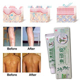 Health psoriasis treatment cream Skin care Dermatitis Eczematoid Eczema Ointment eczema cream psoriasis Itching relief Ointment