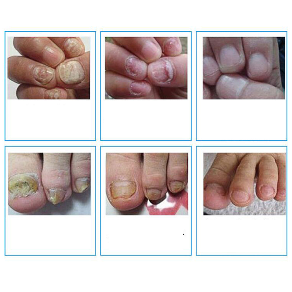 10ml Chinese Medicine Herbs Toe Nail Fungus Treatment Massage Anti Fungal Nail Infection  Nail Care Massage patch D132 Secondary image