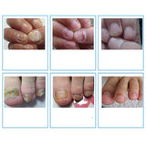 10ml Chinese Medicine Herbs Toe Nail Fungus Treatment Massage Anti Fungal Nail Infection  Nail Care Massage patch D132
