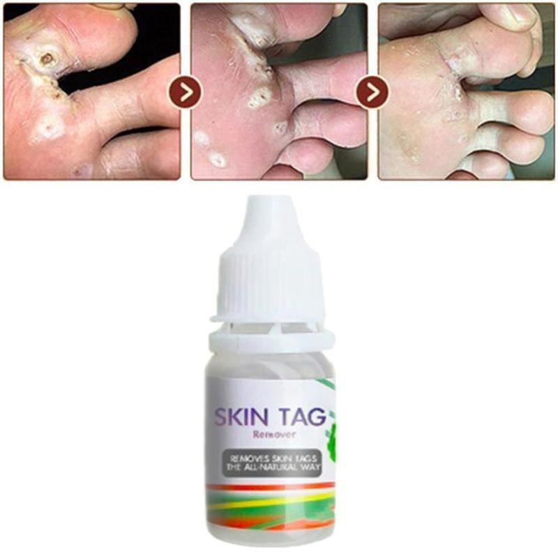 10ML Body Warts Treatment Cream Skin Tag Remover Foot Corn Removal Plantar Genital Warts Ointment Foot Care Cream Dropshopping