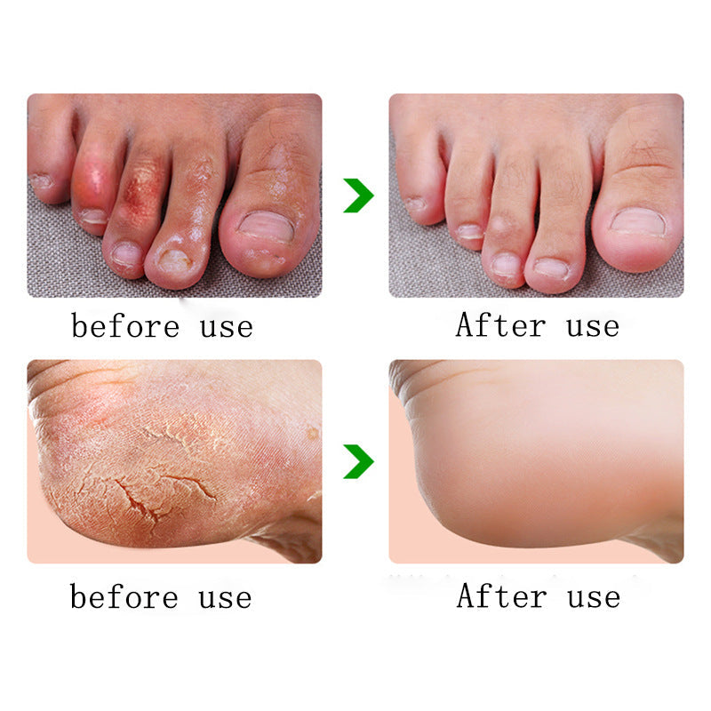 Anti Dry Crack Powerful Frozen Cracking Cream Prevent Repair Skin Dry Chapped Frozen Frostbite Chinese Medicinal Ointment Secondary image