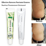 Zudaifu Cream Psoriasis Cream Skin Care Psoriasis Skin Dropshipping Dermatitis Eczematoid Eczema Ointment Treatment Care Cream