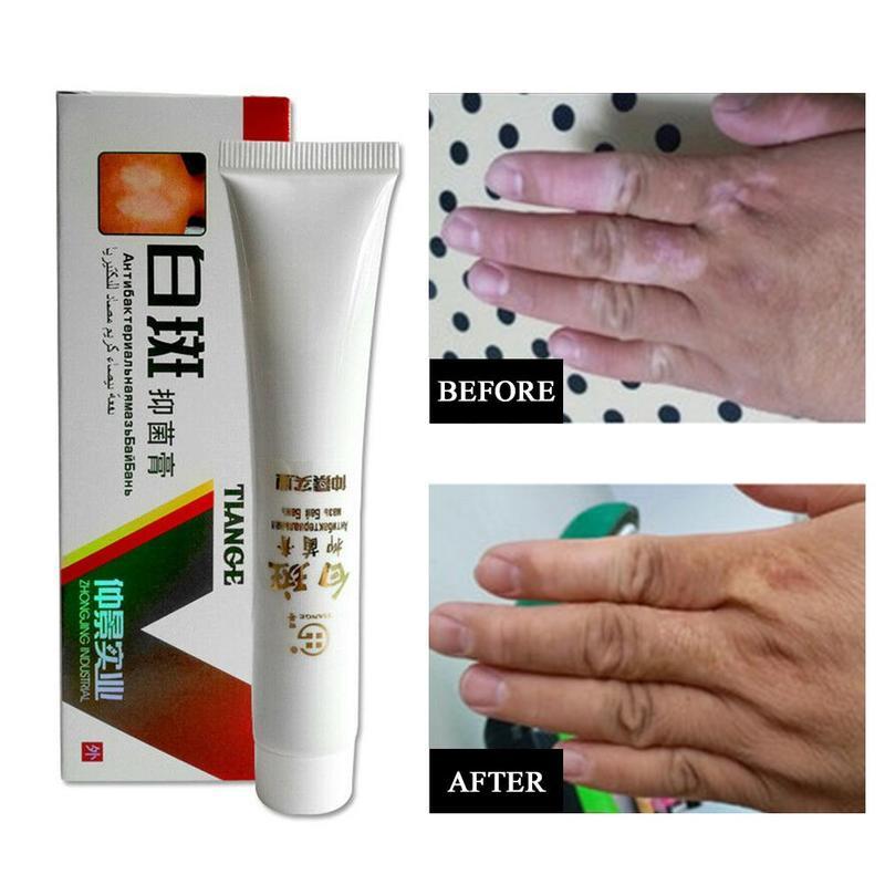 Chinese Medical White Spot Disease Cream Pigment Melanin Promoting Liniment Skin Vitiligo Leukoplakia Disease Treatment 30g Main image