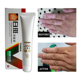 30g Chinese Medical White Spot Disease Cream Pigment  Vitiligo Leukoplakia Disease Treatment Melanin Promoting Liniment Skin