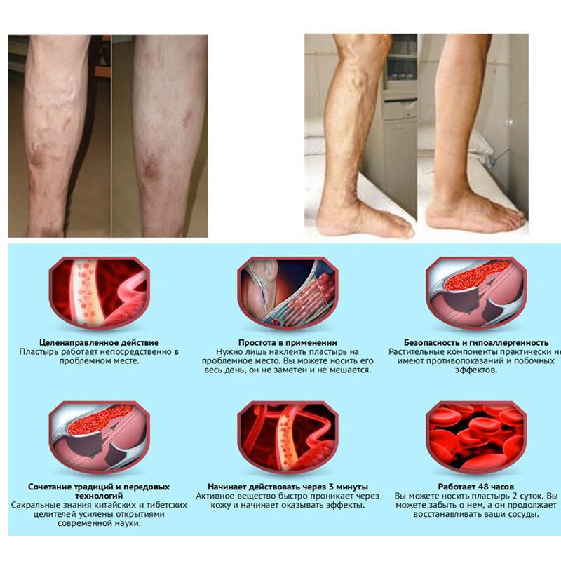 Varicose Veins ointment eins Varicose Treatment Plaster Varicose Veins Cure Patch Vasculitis Natural Solution Herbal Patches Secondary image