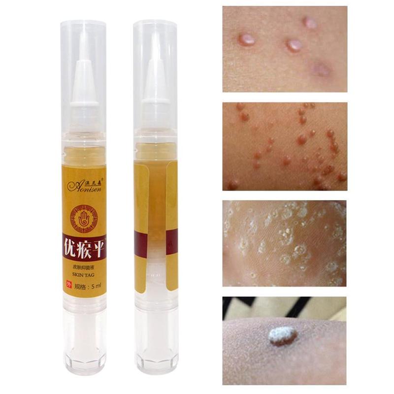 Skin Tag Remover Pen 12 hours Tu kill Medical Tu kill Remover Skin Tag Mole & Genital Wart Remover Foot Corn Removal Pen Secondary image