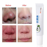 Nose Massage Tools Rosacea Treatment Cream Nose Redness Removal Cleaning Antibacterial Gel Skin Care Product