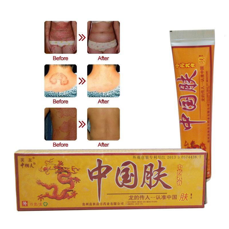 15g Natural Chinese Medicine Herbal Anti Bacteria Cream Psoriasis Eczema Ointment Skin Problem Repair Treatment Health Care Main image
