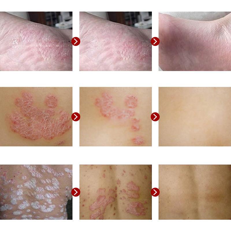 Pifubaodian Powerful Original Psoriasis Dermatitis Eczema Pruritus Skin Problems Cream With Retail Box Skin Care Plaster Main image