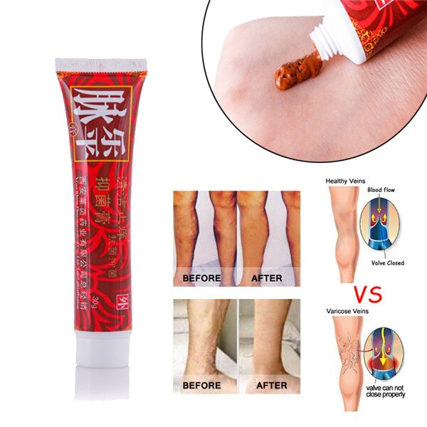 Varicose Veins Treatment Cream Ointment Vasculitis Phlebitis Spider Veins Pain Varicosity Angiitis Remedy Removal Herbal Cream Main image