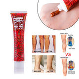 Varicose Veins Treatment Cream Ointment Vasculitis Phlebitis Spider Veins Pain Varicosity Angiitis Remedy Removal Herbal Cream