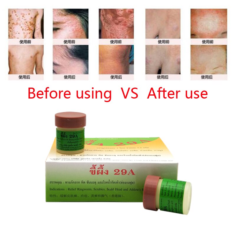 Psoriasis Eczma Cream Works Perfect For All Kinds Of Skin Problems Patch Body Massage Ointment Chinese Medicine 1pc Secondary image