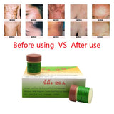 Psoriasis Eczma Cream Works Perfect For All Kinds Of Skin Problems Patch Body Massage Ointment Chinese Medicine 1pc