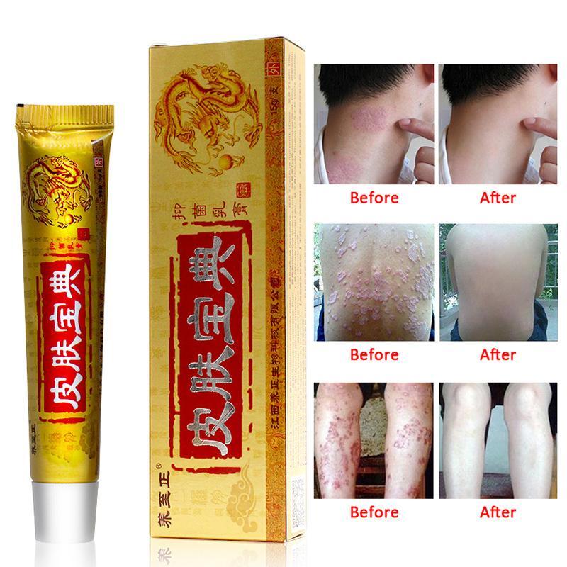 Pifubaodian Powerful Original Psoriasis Dermatitis Eczema Pruritus Skin Problems Cream With Retail Box Skin Care Plaster Main image