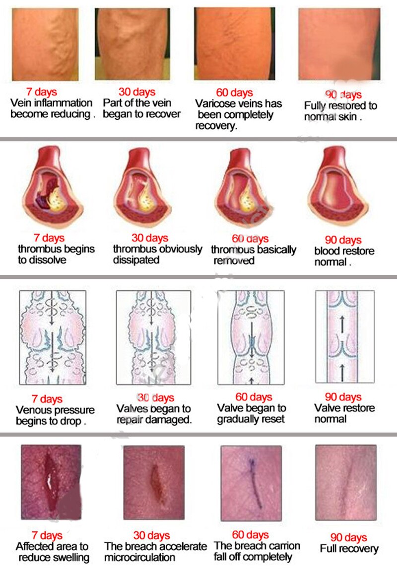 Varicose Veins Treatment Cream Ointment Vasculitis Phlebitis Spider Veins Pain Varicosity Angiitis Remedy Removal Herbal Cream Secondary image
