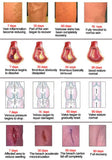 Varicose Veins Treatment Cream Ointment Vasculitis Phlebitis Spider Veins Pain Varicosity Angiitis Remedy Removal Herbal Cream