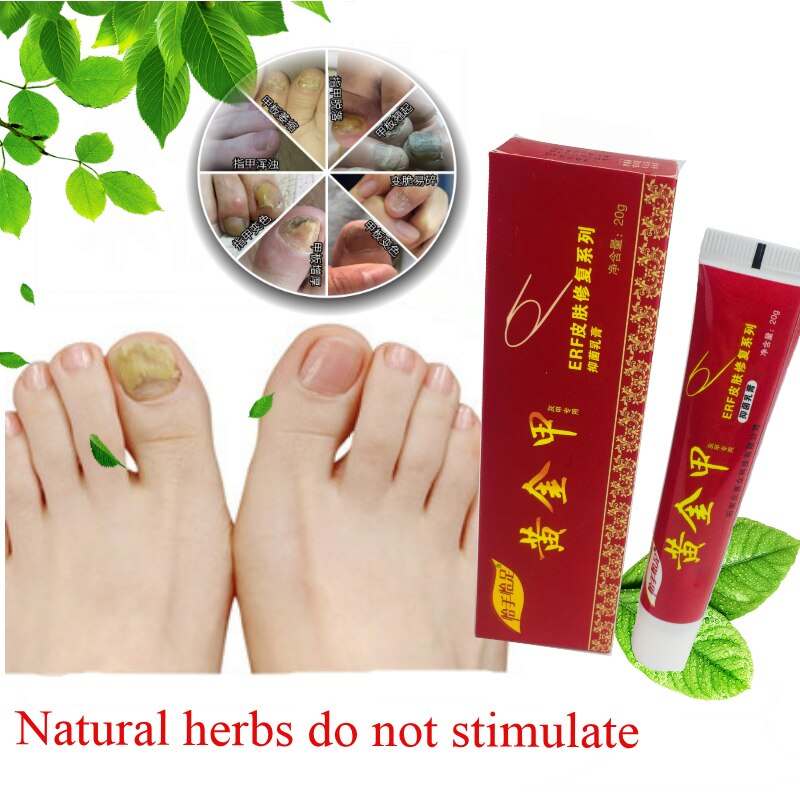 Chinese Medicine Plaster Nail Fungus Treatment Cream Onychomycosis Anti Fungal Nail Infection Fights Bacteria Naturally ointment Main image