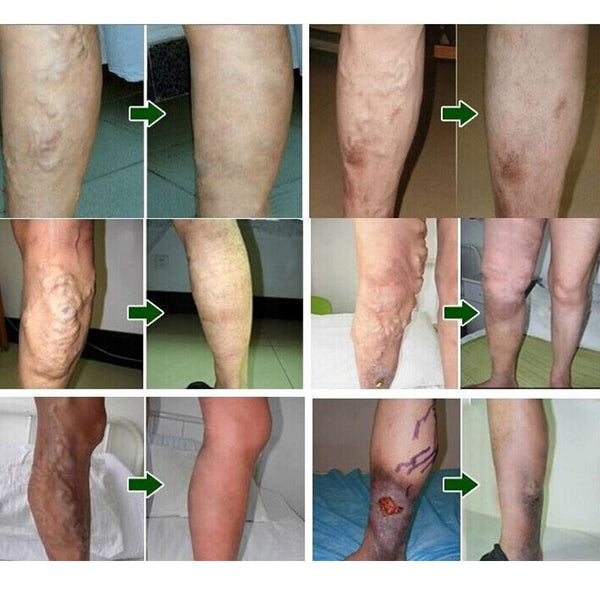 Spider Veins Varicose Treatment Plaster Varicose Veins Cure Patch Vasculitis Natural Solution Herbal Patches 24 Pcs