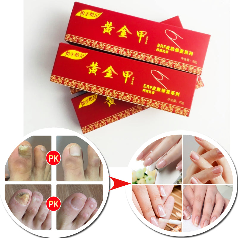 Chinese Medicine Plaster Nail Fungus Treatment Cream Onychomycosis Anti Fungal Nail Infection Fights Bacteria Naturally ointment