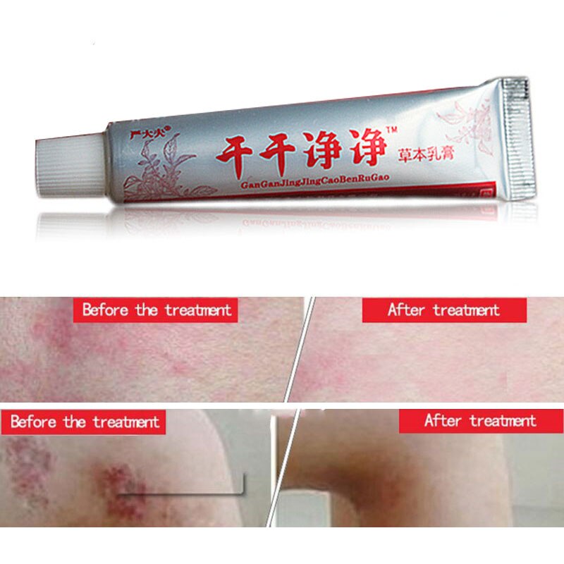Chinese Medicine Body Psoriasis Dermatitis and Eczema Pruritus Psoriasis Skin Problems China Creams Psoriasis Creams Plaster Main image