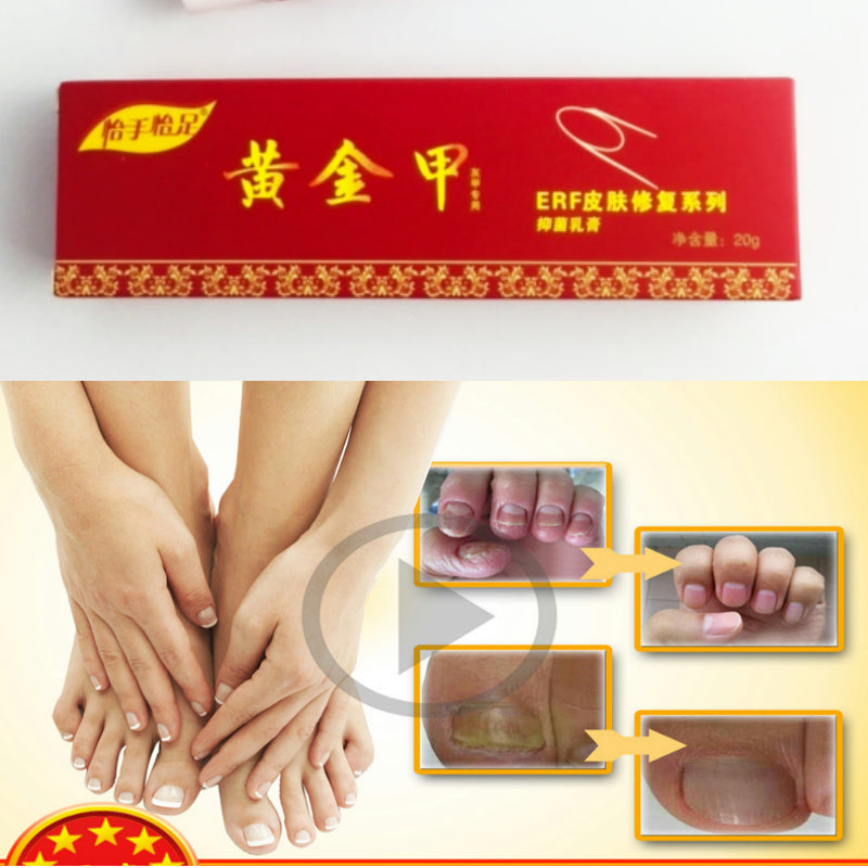 Chinese Medicine Plaster Nail Fungus Treatment Cream Onychomycosis Anti Fungal Nail Infection Fights Bacteria Naturally ointment Main image