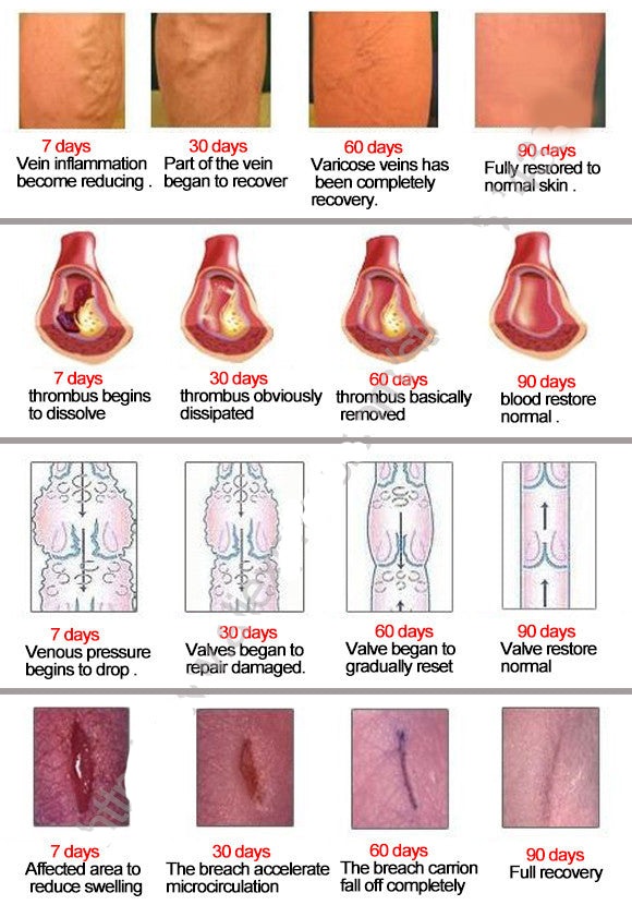 Spider Veins Varicose Treatment Plaster Varicose Veins Cure Patch Vasculitis Natural Solution Herbal Patches 24 Pcs