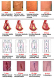 Spider Veins Varicose Treatment Plaster Varicose Veins Cure Patch Vasculitis Natural Solution Herbal Patches 24 Pcs
