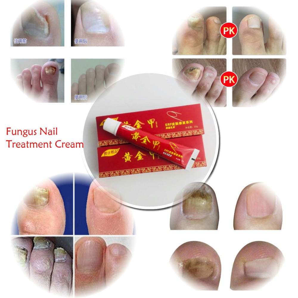 Chinese Medicine Plaster Nail Fungus Treatment Cream Onychomycosis Anti Fungal Nail Infection Fights Bacteria Naturally ointment Secondary image