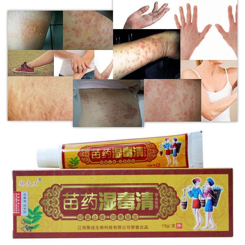 Body Psoriasis Cream Ointment with Retail Box Skin Care Chinese Ointment Cream For All Kinds Of Skin Problems Plaster Secondary image