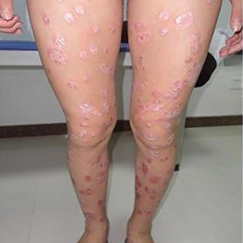Zudaifu Skin Care Cream Skin Psoriasis Cream Dermatitis Eczematoid Eczema Ointment Treatment Psoriasis Cream Secondary image
