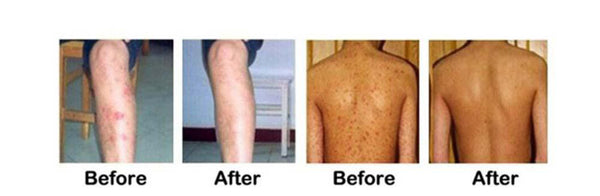 New Body Psoriasis Cream For Dermatitis and Eczema Pruritus Psoriasis Ointment Herbal Creams Skin Care Health Patches