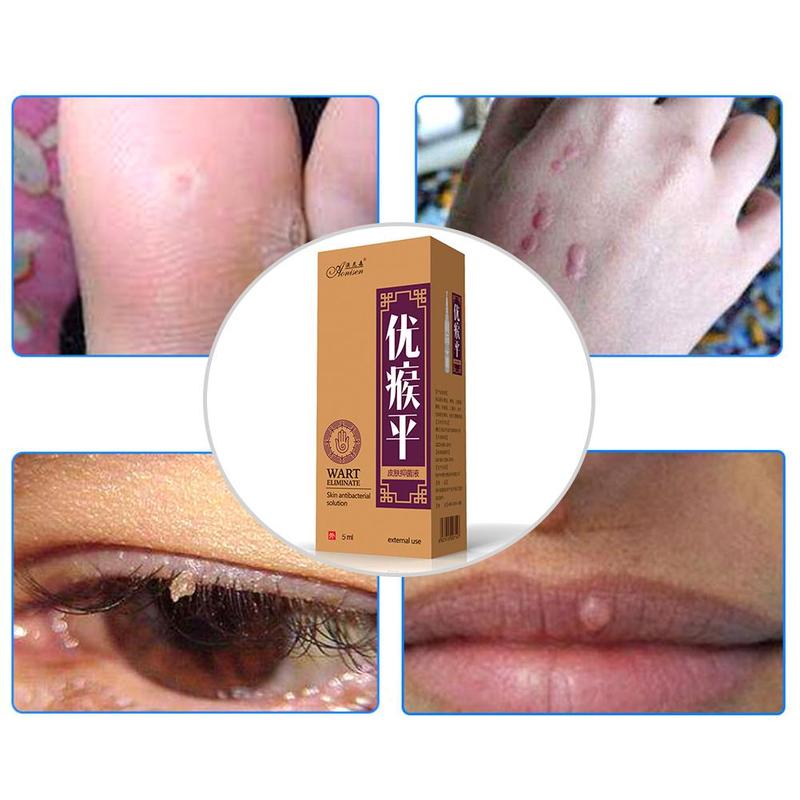 Skin Tag Remover Pen 12 hours Tu kill Medical Tu kill Remover Skin Tag Mole & Genital Wart Remover Foot Corn Removal Pen Secondary image