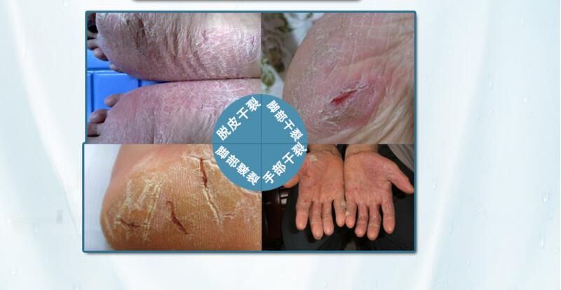 Powerful Chinese Ointment Cream Hand Foot Crack Cream Heel Chapped Peeling Foot and hand Repair Anti Dry Crack skin care Secondary image