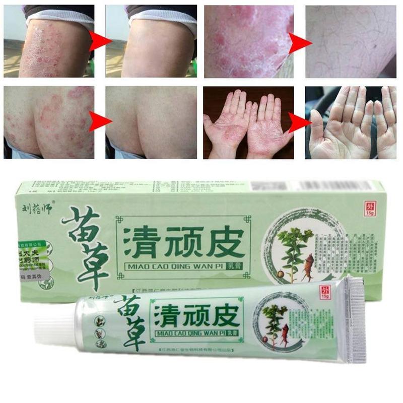 Chinese Herbal Medicine Skin Cream For Anti-itch Allergies Dermatitis Eczema Pruritus Psoriasis Ointment External Use Plaster Secondary image