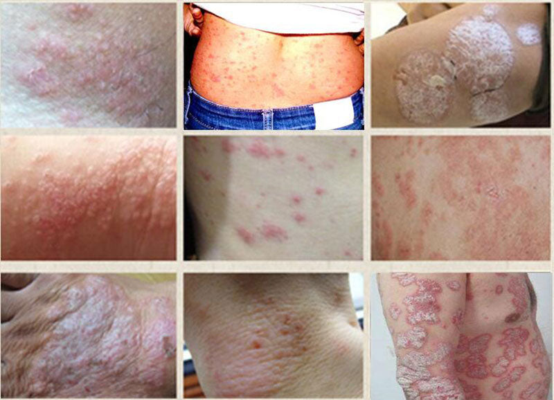 100% Natural Herbal Creams Body Psoriasis Cream Perfect For Dermatitis and Eczema Pruritus Psoriasis Skin Problem Plaster Secondary image