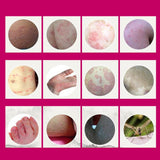 Medical psoriasis Cream Dermatitis Eczema Hand Foot and Ringworm Tinea versicolor  Hemorrhoids Treatment Ointment Health Care