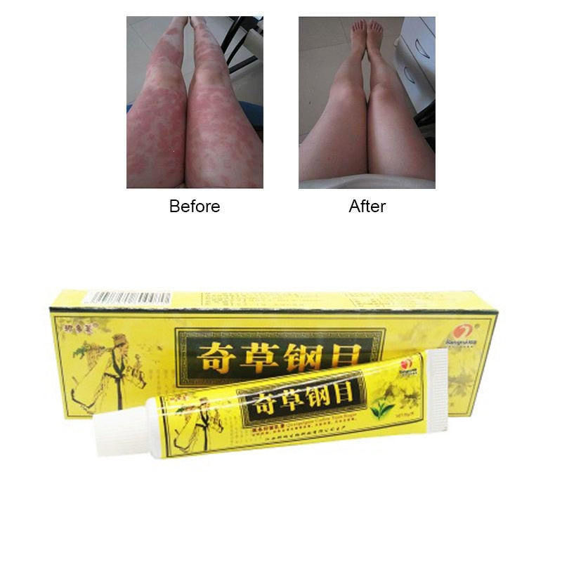 Skin Psoriasis Cream Dermatitis Eczematoid Eczema Ointment Treatment Psoriasis Cream Skin Care Cream medical plaster 1pc Main image