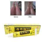 Advanced Body Psoriasis Cream Perfect For Dermatitis and Eczema Pruritus Psoriasis Ointment Herbal Creams
