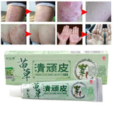 Health psoriasis treatment cream Skin care Dermatitis Eczematoid Eczema Ointment eczema cream psoriasis Itching relief Ointment